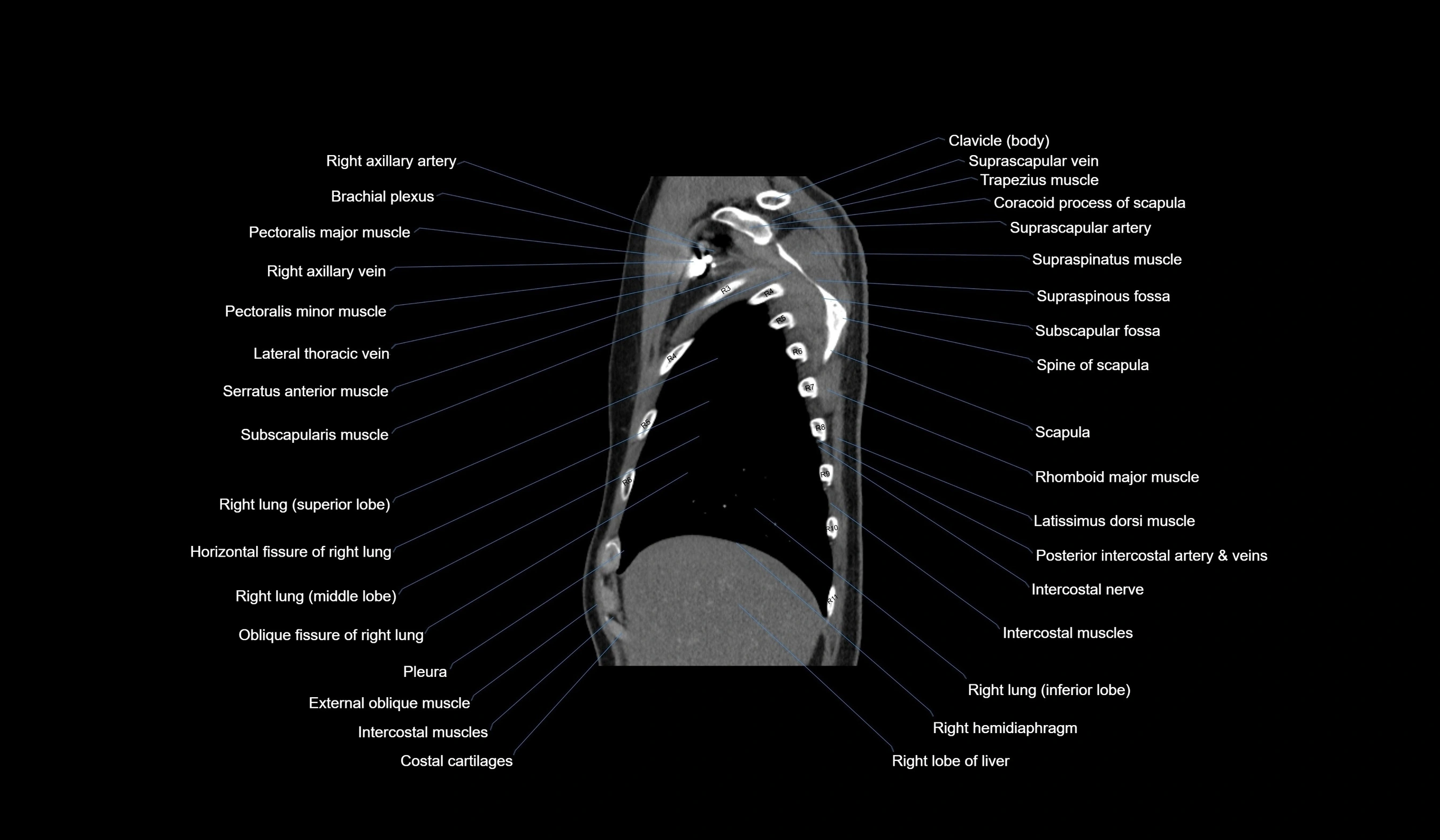 CT chest (thorax) labelled sagittal cross sectional anatomy radiology image-00027.webp